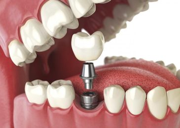 Chi phí trồng răng Implant bao nhiêu tiền 1 cái? Bảng giá mới nhất 2023